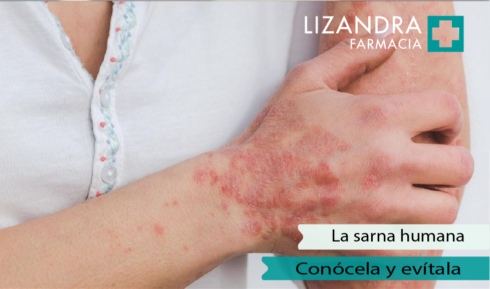 La Sarna Humana Todo Para Conocerla Y Evitarla Blog De Farmacia Lizandra